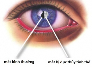 Đục thủy tinh thể bẩm sinh có chữa được không? Cách đối phó với đục thủy tinh thể bẩm sinh 